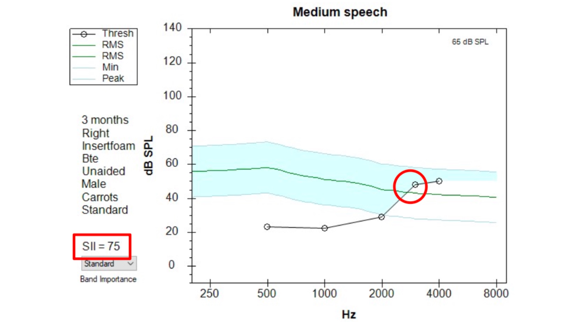 Audiogramm und Sprachverstehen bei mildem Hörverlust