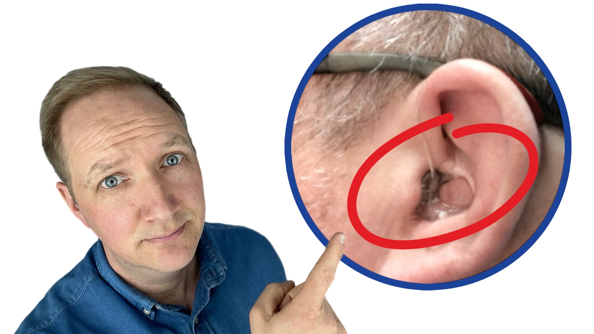 man zeigt mit Finger auf die Otoplastik in einem Ohr